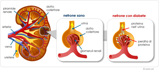 come il diabete danneggia il rene