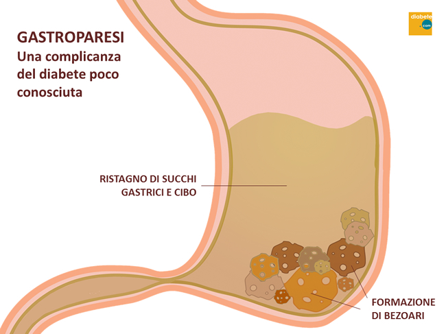 GASTROPARESI Una complicanza del diabete poco conosciuta - FORMAZIONE DI BEZOARI