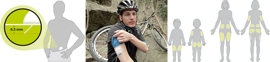 microinfusore cerotto DMT1 diabete