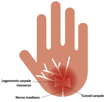 sindrome-del-tunnel-carpale-1