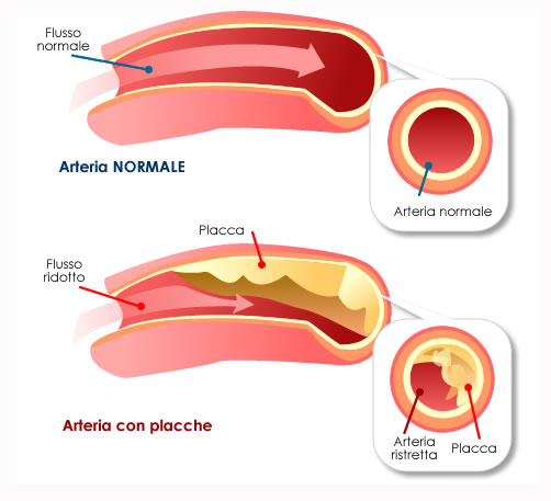 arterie con placche