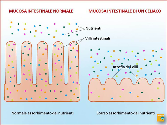 I Villi Intestinali Aumentano La Superficie Di Assorbimento Nel Colon Celiachia: intolleranza permanente al glutine - Diabete.com