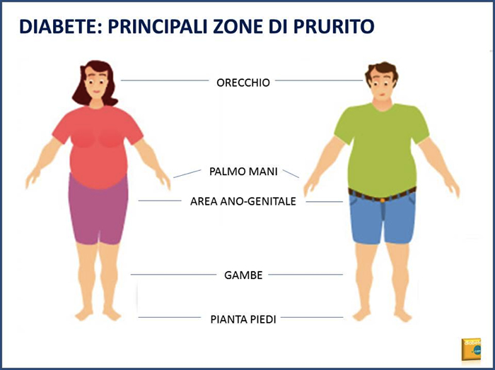 diabete: principali zone di prurito