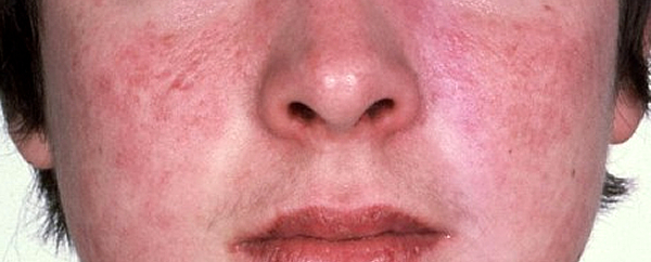 Rubeosis faciei in presenza di diabete: che cos’è?