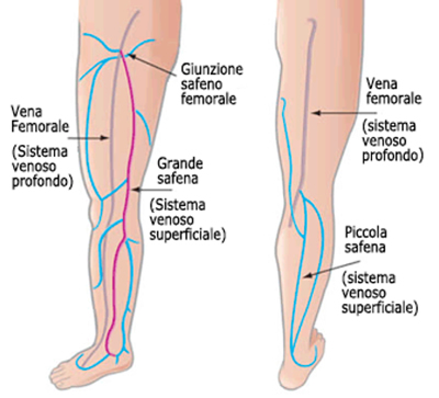 Insufficienza Venosa Cronica (IVC) e Gambe Gonfie - Diabete.com Insufficienza Venosa Cronica (IVC) e Gambe Gonfie - Diabete.com
