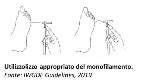 Utilizzo appropriato del monofilamento Semmes Weinstein - Diabete.com