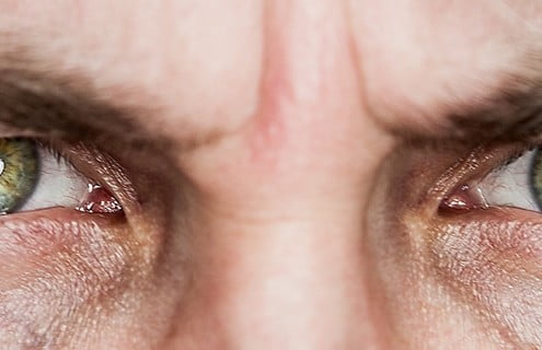 edema maculare diabetico - Diabete.com