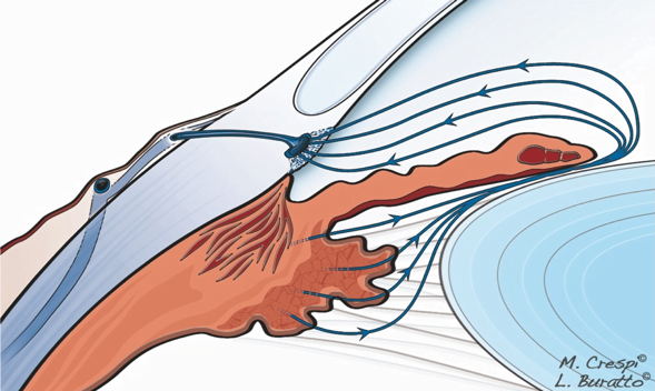 Diagnosi di glaucoma: Circolazione dell’umor acqueo