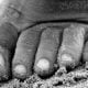 Calli e duroni sul piede: che cosa sono e perché è importante prevenirli e curarli - Diabete.com
