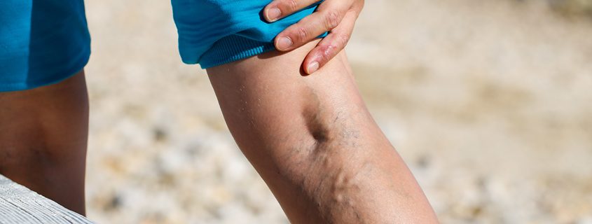 diabete speciale insufficienza venosa cronica
