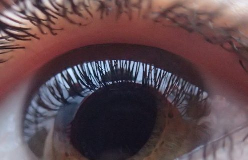 Screening della retinopatia diabetica: prima esperienza italiana di telemedicina