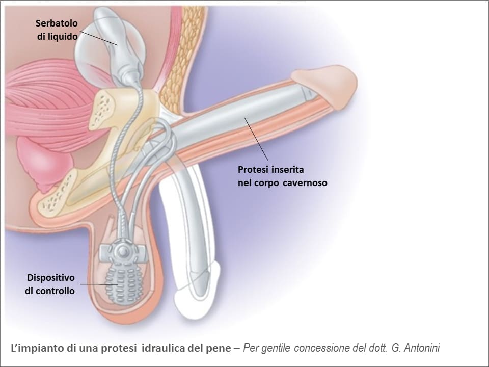 L'impianto di una protesi idraulica del pene