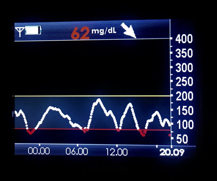 grafico-glicemico-con-ipoglicemia
