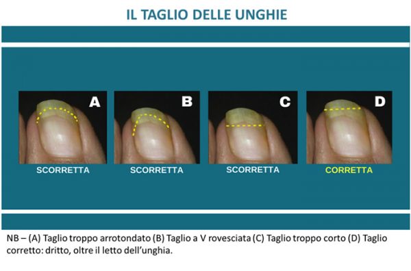 Unghia incarnita: quando e perché si forma? - Diabete.com