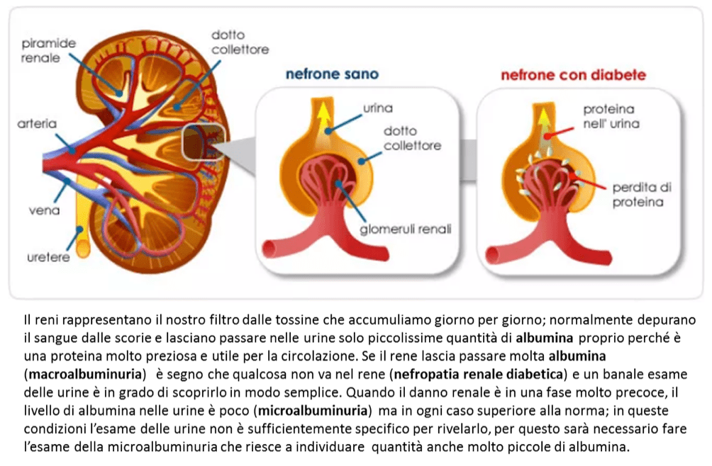 diabetes e nefropatia)