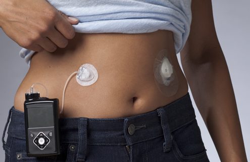 Diabete: disponibile anche in Italia il nuovo MiniMed™ Mio™ Advance