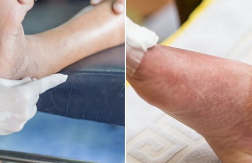 Il piede di Charcot: che cosa è importante sapere
