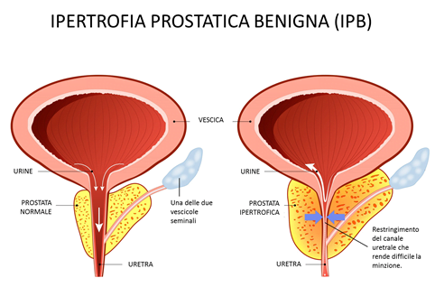 prostata ingrossata misure)