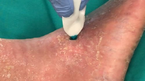 Diabete.com - Terapia fotodinamica per cura delle ulcere nel piede diabetico