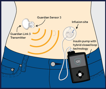 Microinfusore insulina 2019