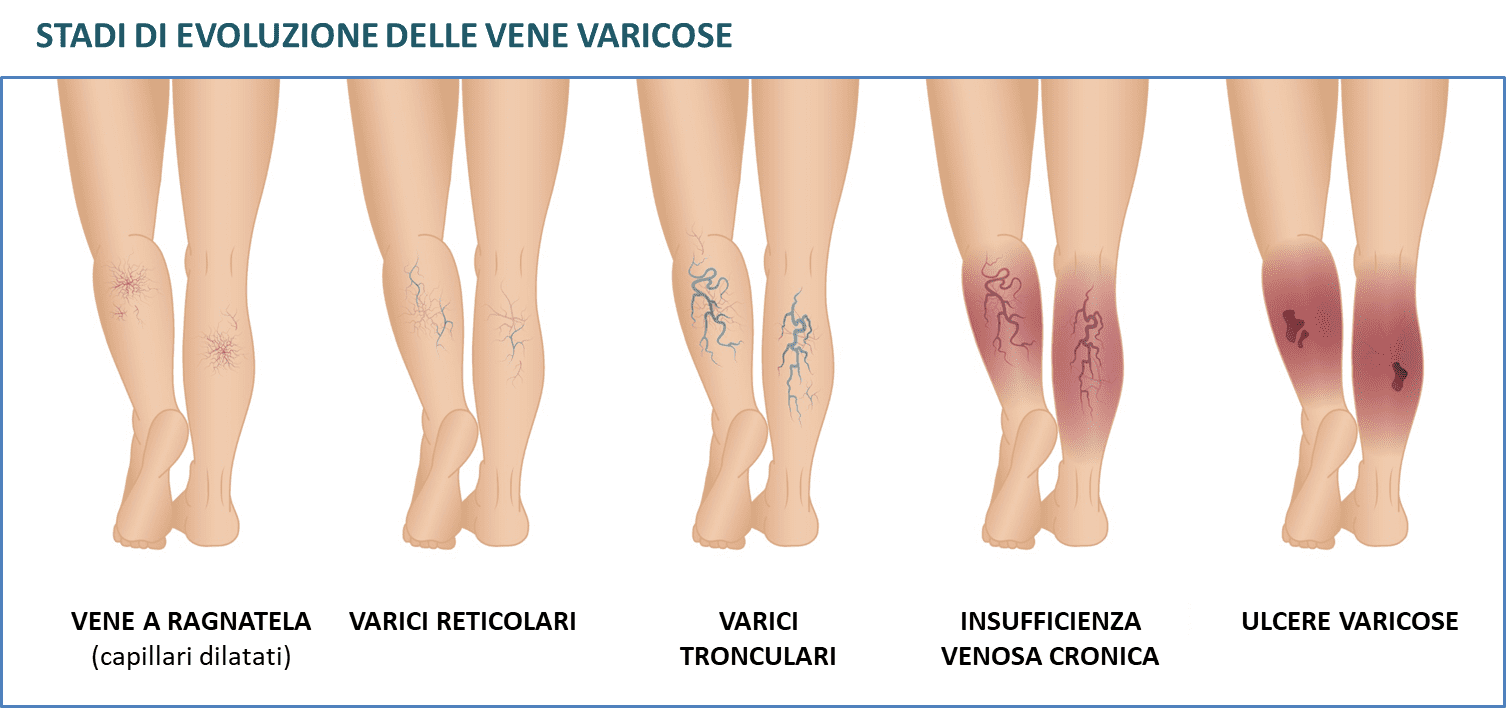 venele laser varicose recenzii