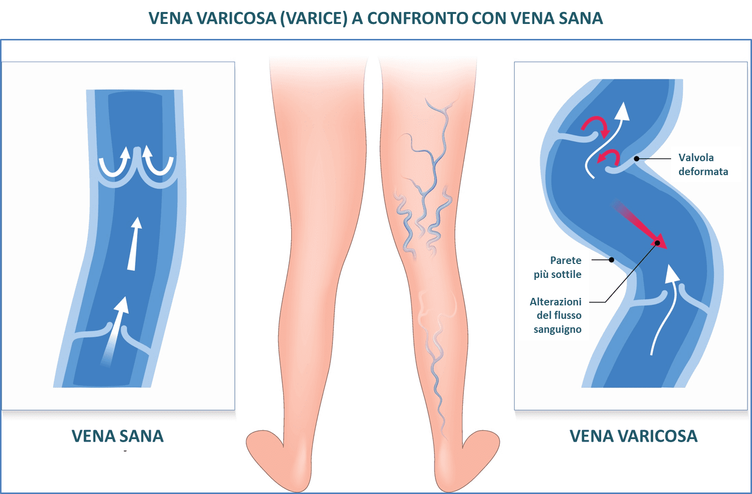 eliminai venele varicoase la recenzii la domiciliu