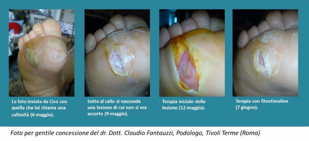 Diabete.com - Lesioni piede diabetico