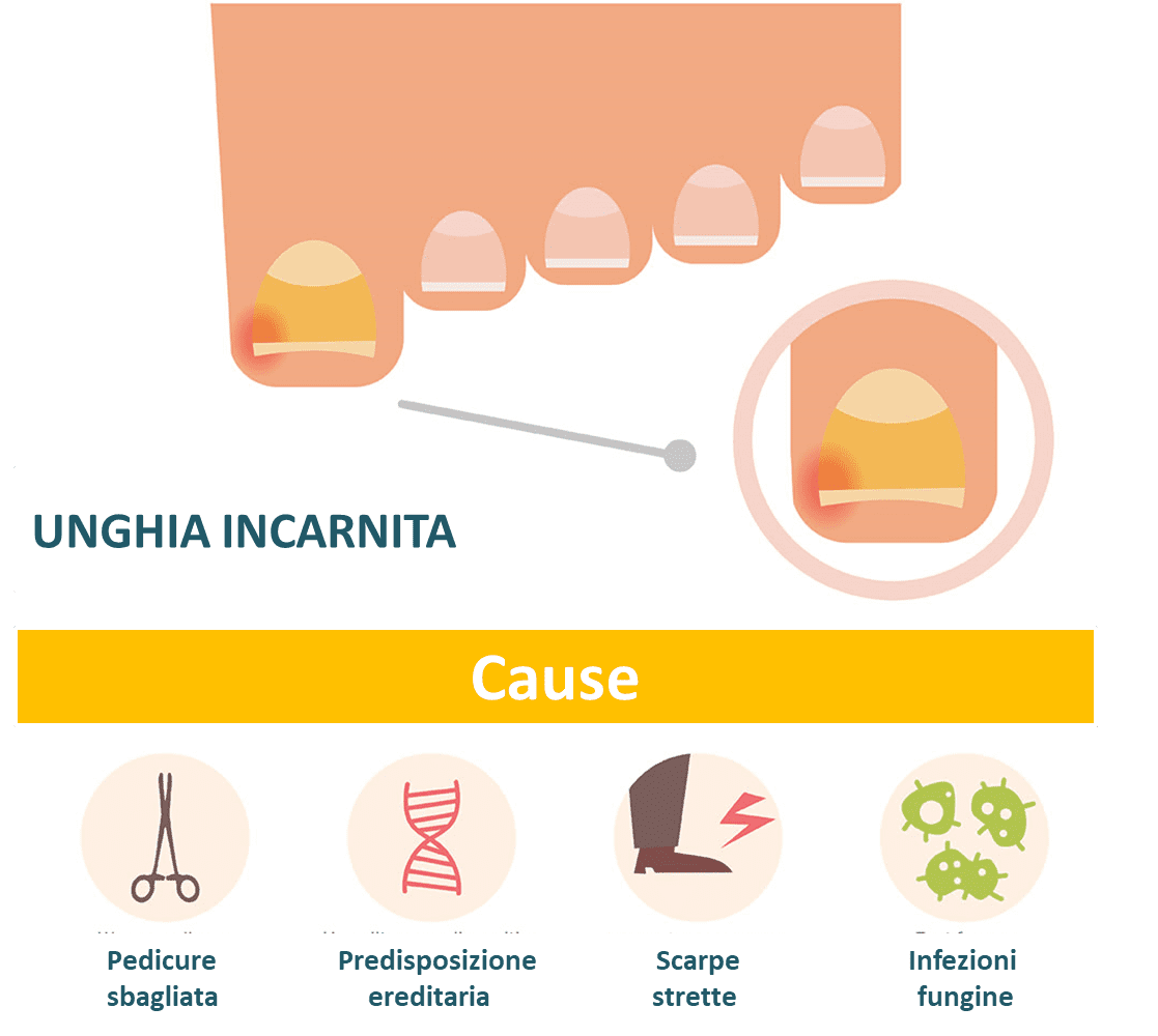 Unghia incarnita