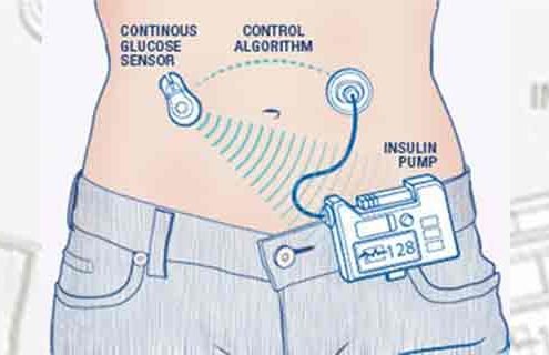 Diabete.com - 6 domande sul Pancreas Artificiale