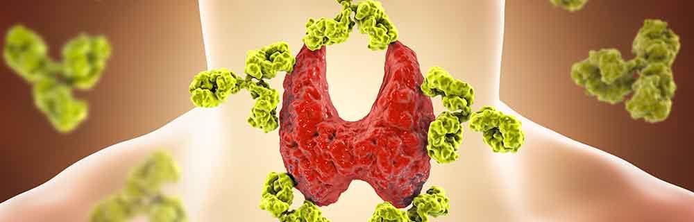 Tiroidite di Hashimoto associata al Diabete tipo 1 e/o malattia di Addison - Diabete.com