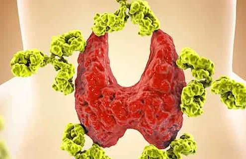 Tiroidite di Hashimoto associata al Diabete tipo 1 e/o malattia di Addison - Diabete.com