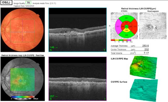 Maculopatia Diagnosi: OCT degenerazione maculare - Diabete.com