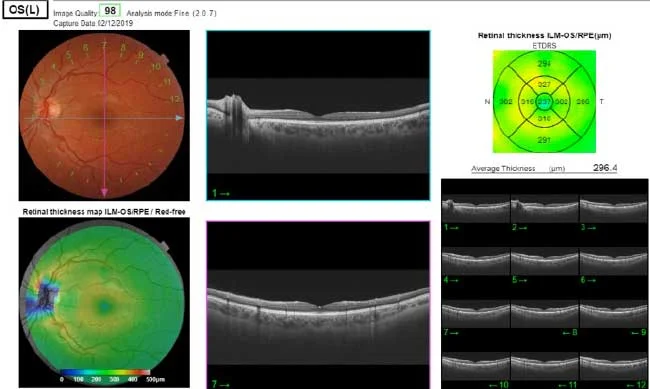 Maculopatia Diagnosi: OCT di una retina sana - Diabete.com