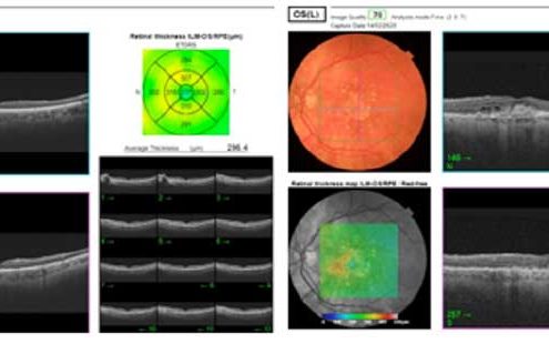 Maculopatia Diagnosi: OCT e Fluorangiografia - Diabete.com