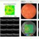 Maculopatia Diagnosi: OCT e Fluorangiografia - Diabete.com