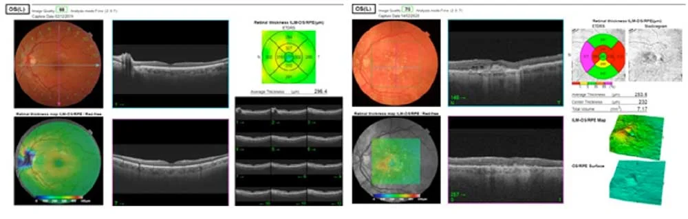 Maculopatia Diagnosi: OCT e Fluorangiografia - Diabete.com