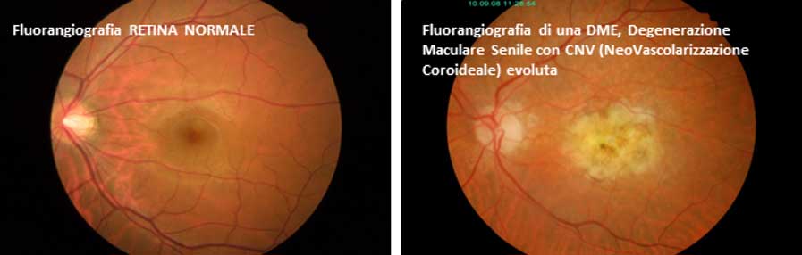 Maculopatia Diagnosi: OCT e Fluorangiografia - Diabete.com