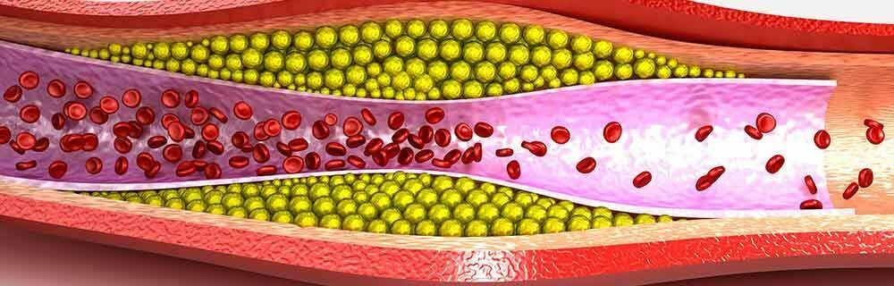 Focus Regione Lombardia: Ipercolesterolemia e rischio cardiovascolare - Diabete.com