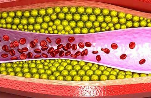 Focus Regione Lombardia: Ipercolesterolemia e rischio cardiovascolare - Diabete.com