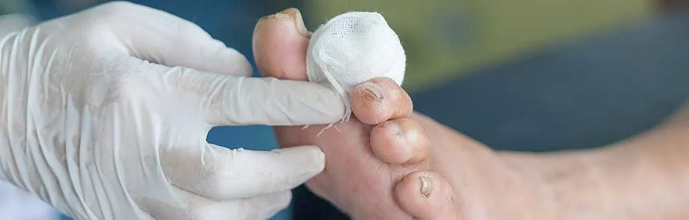 Corsi ECM per Diabetologi Esperti in Piede Diabetico - Diabete.com