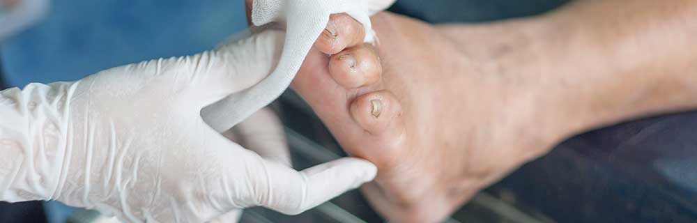 Centro Piede Diabetico Bari: Presidio Ospedaliero Umberto I - Diabete.com