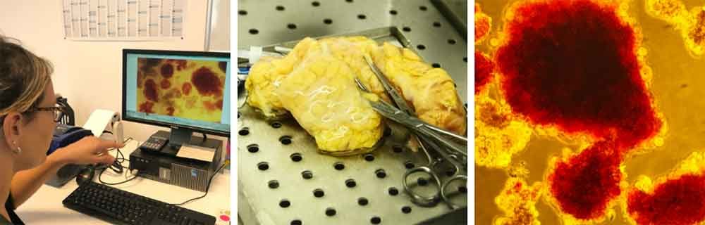 Trapianto Pancreas e Isole Pancreatiche Niguarda - Diabete.com