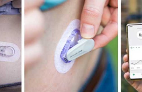 Sistema Cgm Dexcom One in Italia: firmato accordo di distribuzione