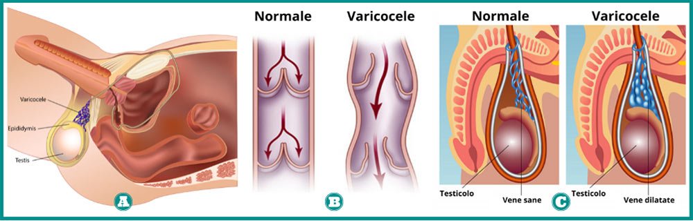 Diabete e varicocele: che cos’è, quali sintomi, come si cura?