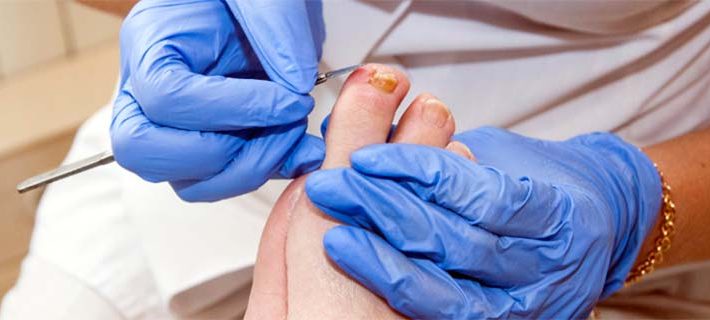 Piede diabetico: in Lombardia 17 centri per prevenzione, diagnosi e cura