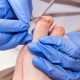 Piede diabetico: in Lombardia 17 centri per prevenzione, diagnosi e cura