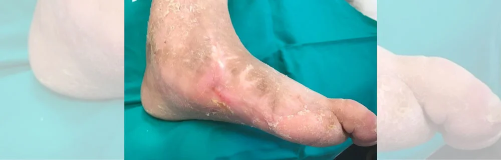 La terapia cellulare autologa per il piede diabetico ischemico