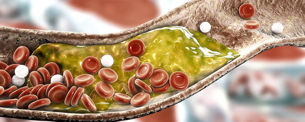 Arteria - arterosclerosi