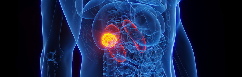 Tumore del rene: diagnosi precoce con biopsia liquida e intelligenza artificiale