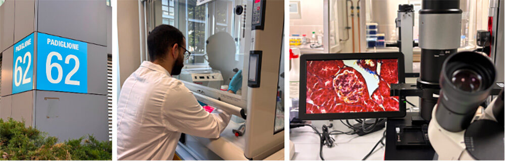 Fibrosi e diabete tipo 1: una complicanza silenziosa da conoscere meglio